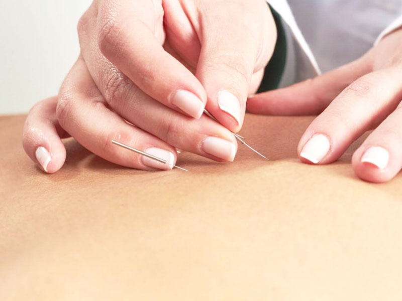 Châm cứu điều trị bại liệt