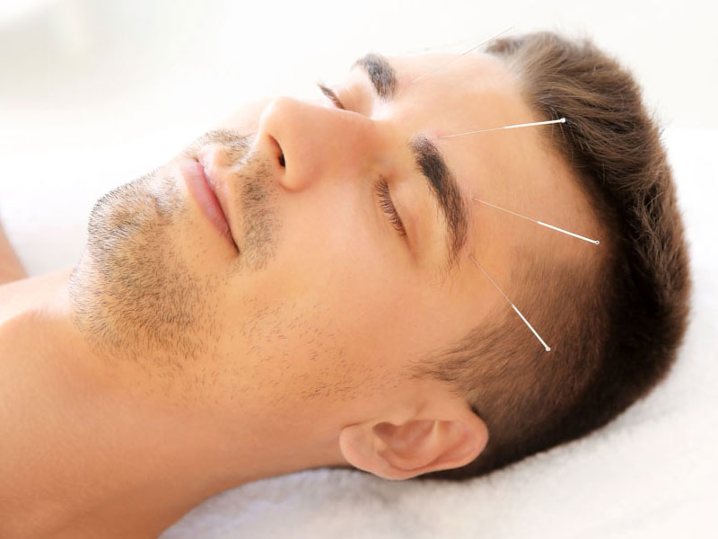 Châm cứu điều trị bệnh cúm