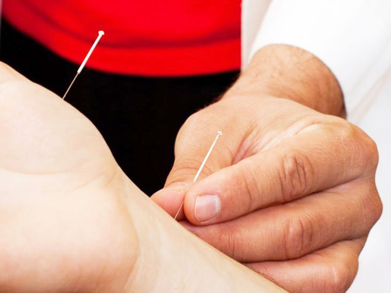 Châm cứu điều trị bệnh đau cánh tay