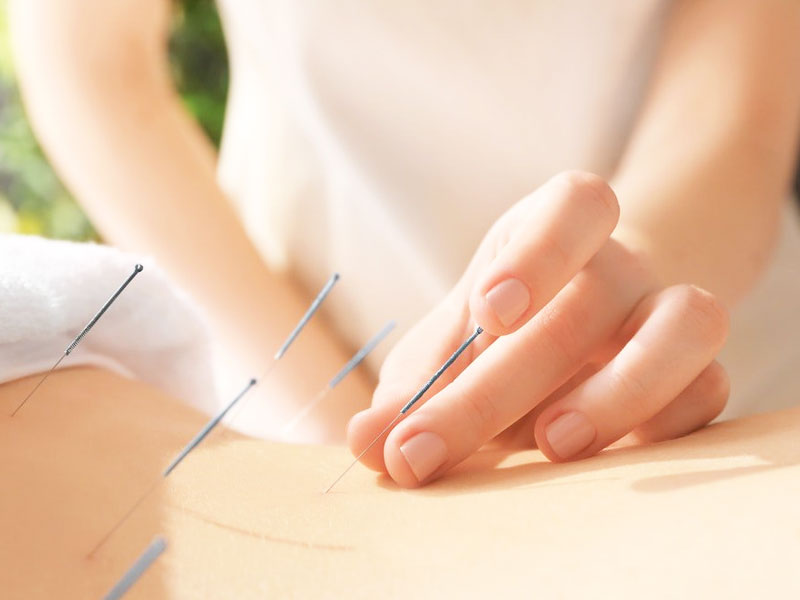 Châm Cứu Đau Thần Kinh Tọa: Lưu ý, chi phí, uy tín Hà Nội