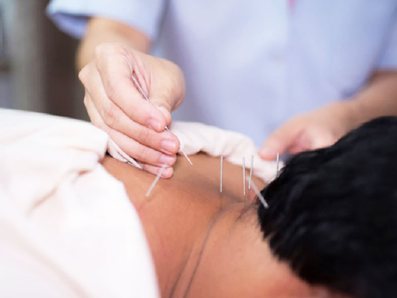 Châm cứu điều trị bệnh cổ trướng