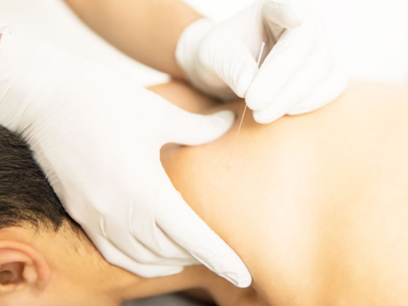 Châm cứu điều trị bệnh đau cột sống