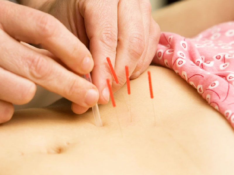 Châm cứu điều trị bệnh đại tiện ra máu