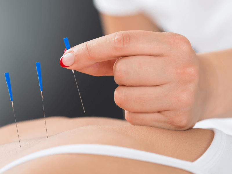 Châm Cứu Điều Trị Bệnh Đau Lưng