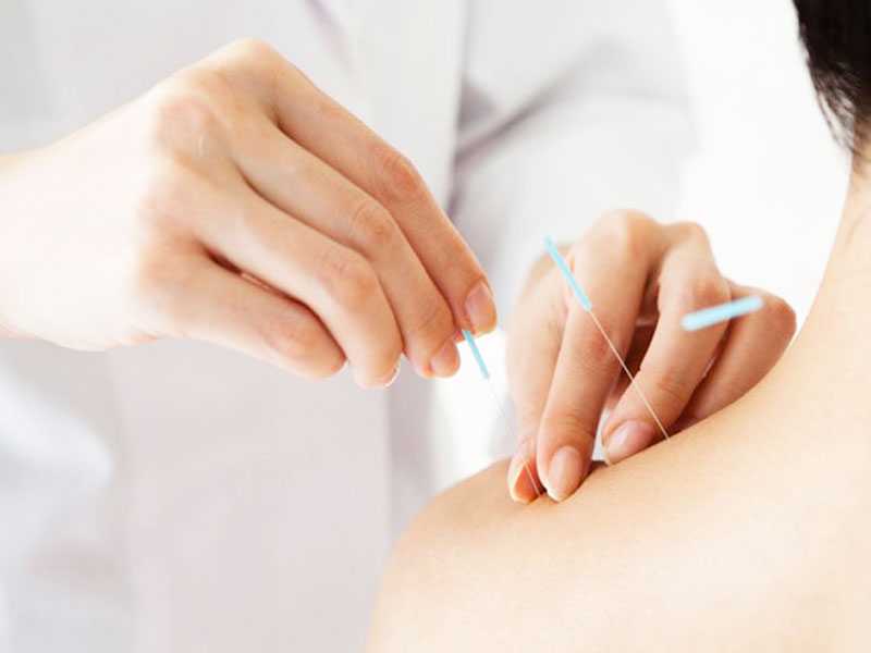 Hợp Châm: Hợp Pháp Trong Châm Cứu