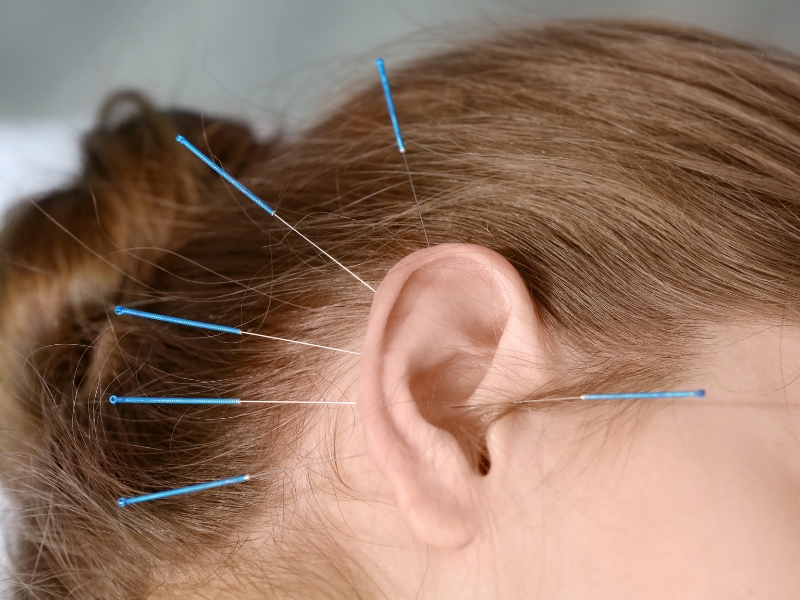 Huyệt Lạc (Luo Connecting Points - Lạc Huyệt) là gì?