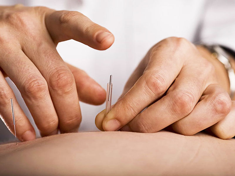 Những tác dụng phụ của châm cứu cần lưu ý