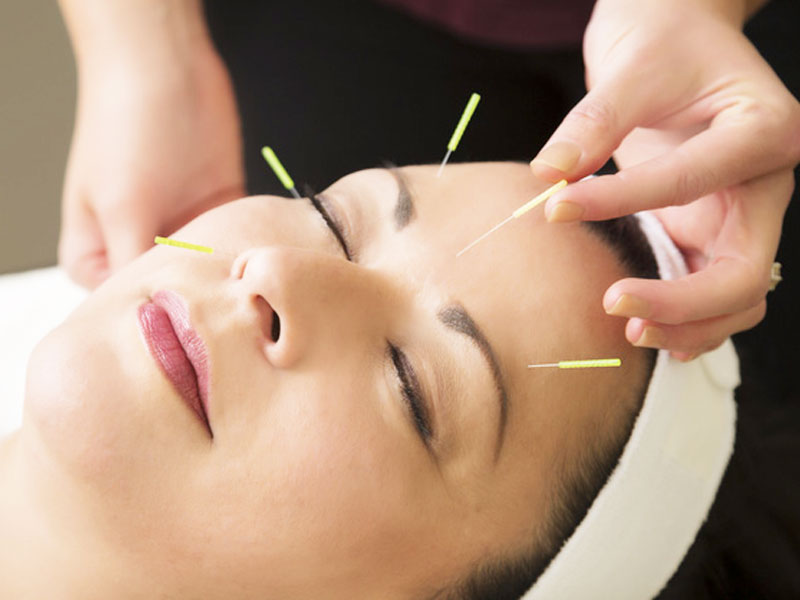 Châm cứu chữa bệnh thần kinh