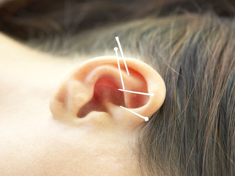 Châm cứu điều trị ù tai: Phương huyệt, tác dụng, lưu ý