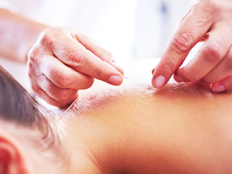 Châm cứu điều trị Zona thế nào? Và cần lưu ý gì?